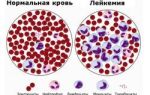 Какой анализ крови показывает онкологию – можно ли ее определить?