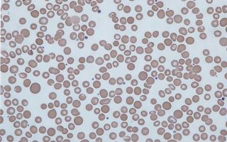 Анизоцитоз в общем анализе крови – что это такое?