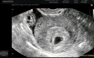 Узи на 4 неделе беременности: нормы, фото