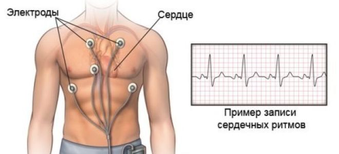 Холтеровский мониторинг экг: [что это, расшифровка]