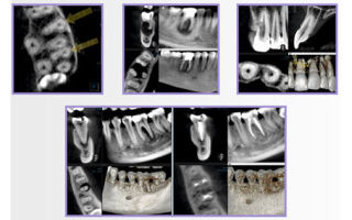 Компьютерная томография зубов (кт): как проходит, для чего делают?