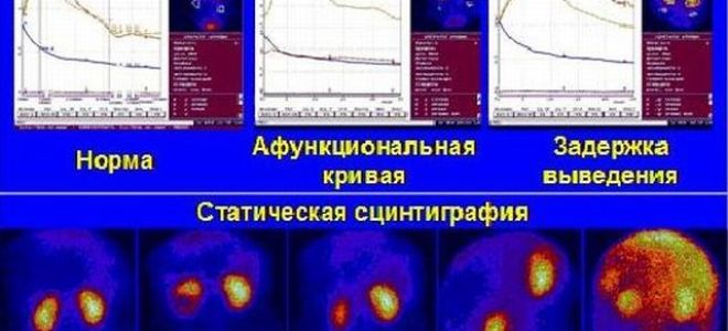 Сцинтиграфия почек: динамическая и статическая