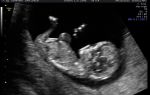 Фото размера плода на узи на 11 неделе беременности: что видно?