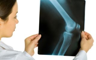 Рентген коленного сустава: что показывает, как выглядит здоровый сустав?