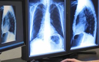 Рентген грудного отдела позвоночника – что показывает?