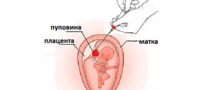 Кордоцентез: сроки проведения, последствия