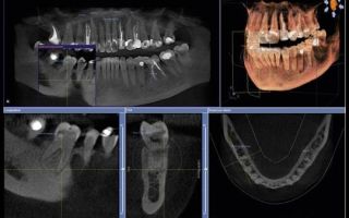 Компьютерная томография (кт) челюсти – как делают?