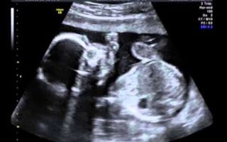 Допплерография при беременности [расшифровка] 8 глав
