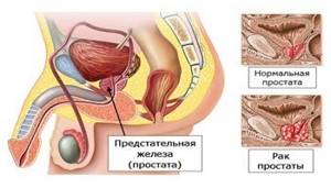 Трансректальное УЗИ простаты и предстательной железы