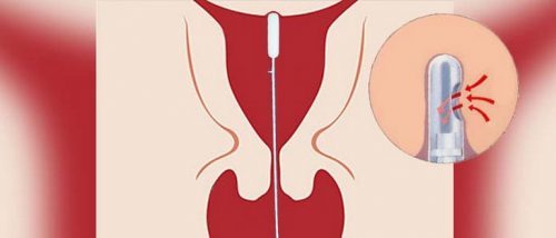 Пайпель-биопсия эндометрия: что это такое, как проводится, результаты