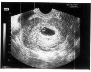 Фото размера плода на УЗИ на 6 неделе беременности: что покажет и как делают?