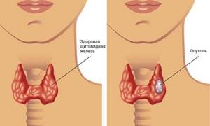 Биопсия щитовидной железы: как делают, показания к проведению, результаты
