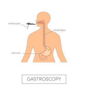 ФГС желудка (фиброгастроскопия): как делается?