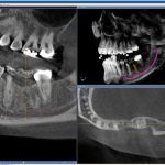 Компьютерная томография зубов (КТ): как проходит, для чего делают?