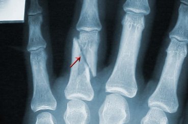 Рентген руки и кисти: фото, особенности
