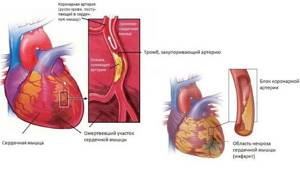 ЭКГ при инфаркте миокарда: признаки, фото, расшифровка
