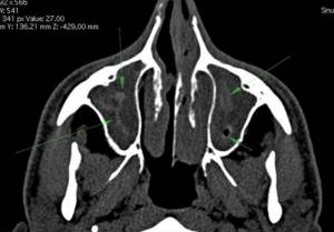 Компьютерная томография (КТ) придаточных пазух носа – что показывает?