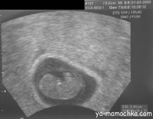 Фото многоплодной беременности на УЗИ: когда видно?