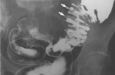Рентген кишечника: как делают и что показывает?