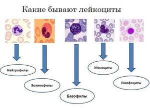 Норма лейкоцитов в крови и причины отклонения