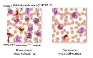 Понижены лейкоциты в крови у ребенка: причины, лечение