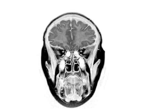 Что показывает МРТ головного мозга: расшифровка результатов