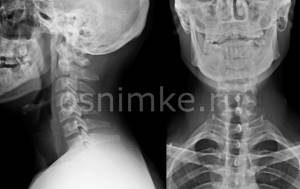 Рентген шейного отдела позвоночника: что показывает?