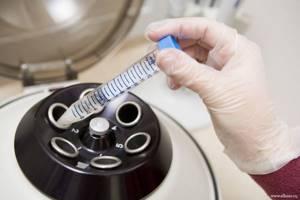 Лейкоциты в сперме: норма, причины повышения, лечение и профилактика