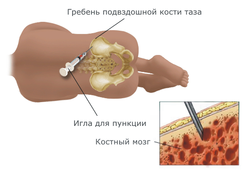 Биопсия костного мозга: описание процедуры, как проводится?