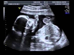 Доплер УЗИ при беременности: что это такое, нормы, когда делают?