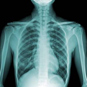 Рентген легких: как часто можно делать, что показывает? (с фото)