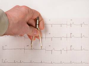 ЭКГ сердца: что показывает, расшифровка, как подготовиться?