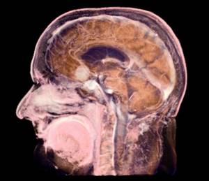 Компьютерная томография головы (КТ) – что показывает?