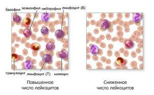 Норма лейкоцитов в крови у детей (таблица) и причины отклонения