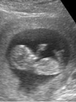 УЗИ скрининг на 12 неделе беременности: нормы, фото, как делают?