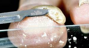 Анализ на грибок ногтей: где и как сдать?