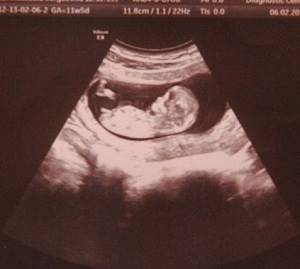 Фото УЗИ на 12 неделе беременности: пол ребенка, норма, расшифровка