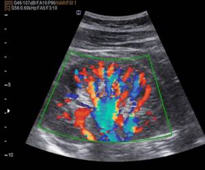 УЗИ почечных артерий: подготовка, как проходит?