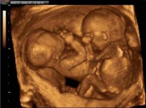 4Д-УЗИ при беременности: фото, что видно?
