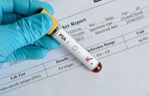 Анализ крови на ПСА: что означает, расшифровка, подготовка и нормы