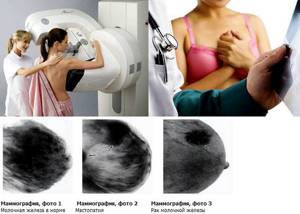 Маммография молочных желез: что это такое и как ее делают?