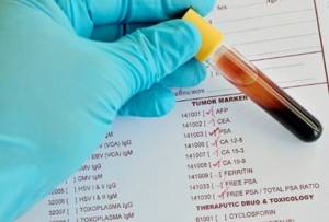 Анализ крови на онкомаркеры – что показывает?