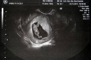 УЗИ на 5 неделе беременности: фото, что покажет?