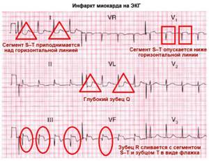 Что показывает ЭКГ сердца – видно ли на нем проблемы?