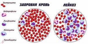 Анализ крови при лейкозе у детей и взрослых: признаки и симптомы