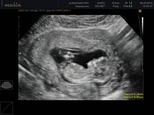 УЗИ скрининг на 12 неделе беременности: нормы, фото, как делают?