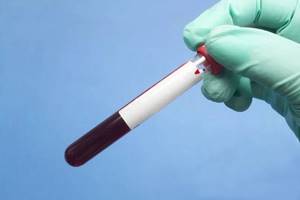 Анализ крови на ХГЧ: расшифровка результатов, когда сдавать?