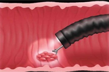 Гастроскопия желудка: как делают с зондом и без его глотания?