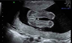 УЗИ на 17 неделе беременности: фото, показатели
