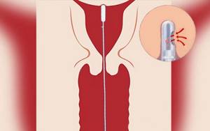 Аспирационная биопсия эндометрия: что это, как проводится процедура?